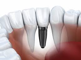 However, it's important to understand the type of treatment you need and what your plan will pay for before moving forward. Say Goodbye To Yesterday S Iffy Dental Implants Chicago Tribune
