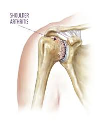 total shoulder replacement surgery