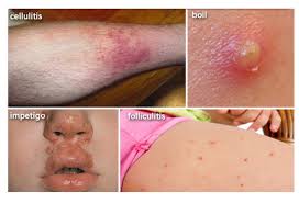 Image result for bacterial skin infection