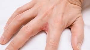 managing dyshidrotic eczema causes and