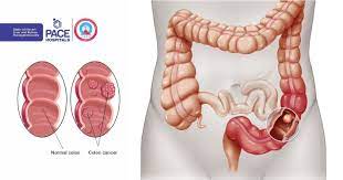 colon cancer symptoms causes