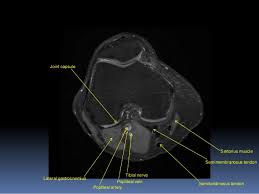 Functional anatomy of the shoulder complex malcolm peat the shoulder complex, together with other joint and muscle mechanisms of the upper limb. Mri Knee Joint Anatomy