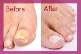 how to use coconut oil for nail fungus
