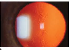 Anterior basement membrane corneal dystrophy. Corneal Dystrophies Ento Key