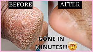 remove dead skin cells from your feet