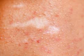 10 common bacterial skin infections