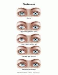 For over 20 years of my life i had to live with not being able to make eye contact with others. Strabismus Eye Turn Center For Vision Learning