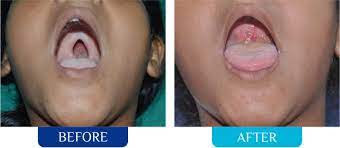 cleft lip palate surgery face