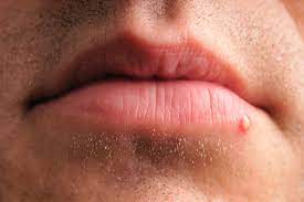 cold sore or pimple how to tell what