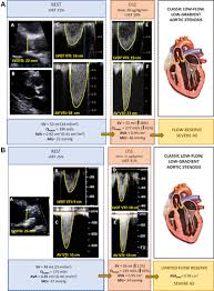 Aortic Valve Area And Gradient