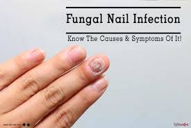 fungal nail infection know the causes
