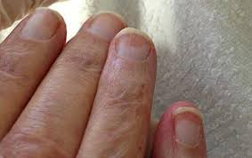 Nail Abnormalities Causes Symptoms And Pictures