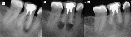 tooth 46 with apical periodonis in