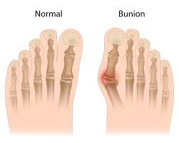 Image result for BUNIONS