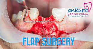 gingival flap surgery symptoms