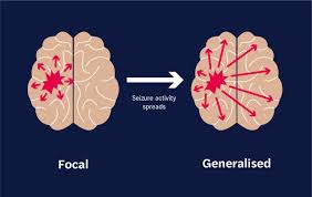 what are focal onset seizures seer