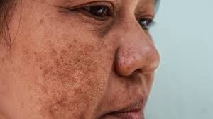 melasma mustache causes treatment vs