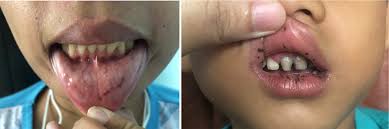black spots on the lips of the patient