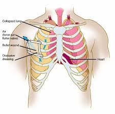 The circulatory system does most of its work. Anatomy Atlases Anatomy Of First Aid A Case Study Approach Sucking Chest Wound