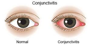 conjunctivitis what you need to know