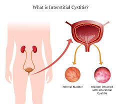 intersial cysis symptoms