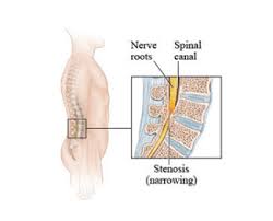spinal stenosis pearland tx lake