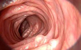 bacterial infection after colonoscopy