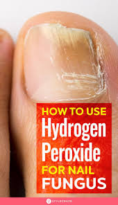 When using this type of solution, it's important to make sure your ratios are correct. How To Use Hydrogen Peroxide For Nail Fungus A Step By Step Guide Toe Fungus Remedies Treating Toenail Fungus Nail Fungus Treatment