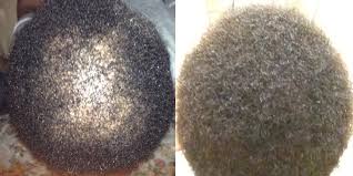 I was avoiding many social situations before as i was constantly worried by my. Young African American Female S Hair Transplant Results Latest News Updates About Hair Transplants