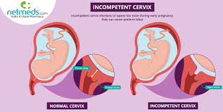 incompetent cervix cervical