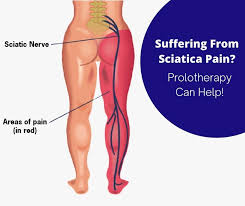 sciatica pain without surgery