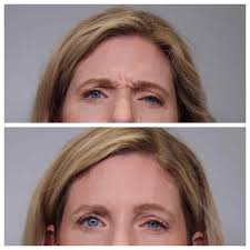 best botox before and after in houston