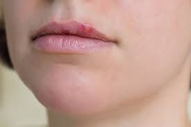 what causes cold sores how to treat