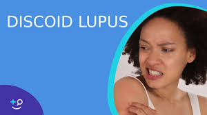 discoid lupus erythematosus american
