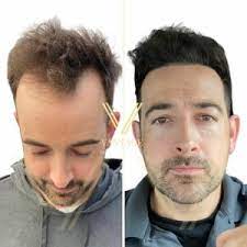 hairline transplant before after