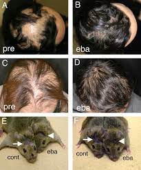 Brown states, this combo thickens and lengthens hair and reverses many types of alopecia (hair loss) such as genetic thinning (e.g., male pattern baldness), chemical and stress related hair loss and other types of hair loss. Experimental Evaluation Of Ebastine A Second Generation Anti Histamine As A Supportive Medication For Alopecia Areata Journal Of Dermatological Science