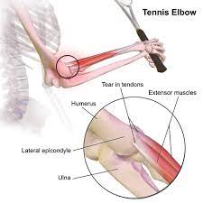 Zobacz ćwiczenia, które pomogą ci uwolnić się od uciążliwych dolegliwości. File Tennis Elbow Png Wikimedia Commons