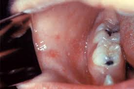 F the roof of the mouth often turns yellow when a patient is suffering from oral thrus. Covid 19 May Manifest In The Mouth In Some Patients Medpage Today