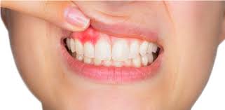 8 gum abscess symptoms you should know