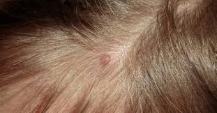 here s how to treat pimples on scalp