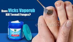 does vicks vaporub kill toenail fungus