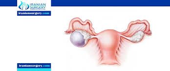 Ovarian Cyst Size Chart Ovarian Cyst Size For Surgery