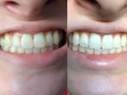 The best thing about coconut oil is that you can even use it on sensitive teeth. I Used Activated Charcoal To Whiten My Teeth And It Worked