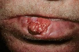 lip cancer pictures causes symptoms