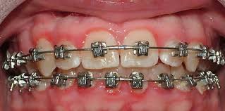 gum inflammation with braces all you