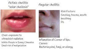 dry lips cheilitis chapped lips