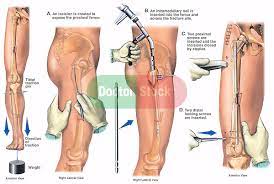 leg surgical fixation of femur fracture