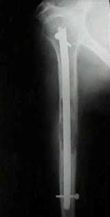 im nailing of humeral shaft frx