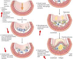 Atherosclerosis Ppt Video Online Download