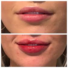 lip filler after care delle chiaie